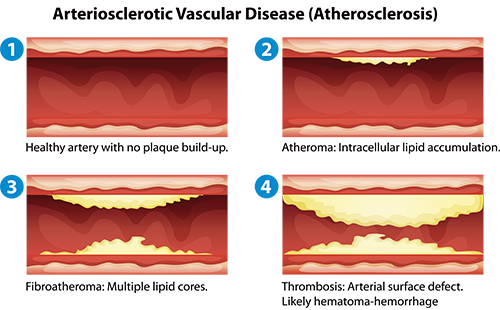 動(dòng)脈硬化檢測(cè)儀