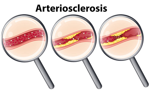 動(dòng)脈硬化檢測(cè)儀